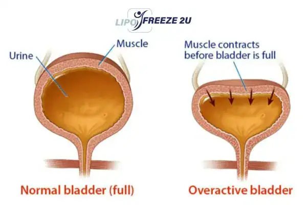 diagram of overactive bladder treatment Basildon