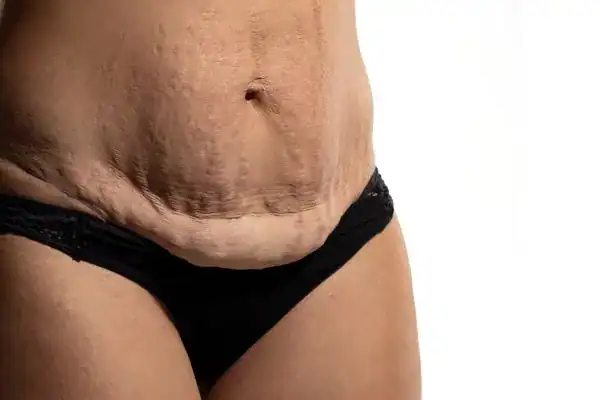 loose skin after weight loss injections Basildon