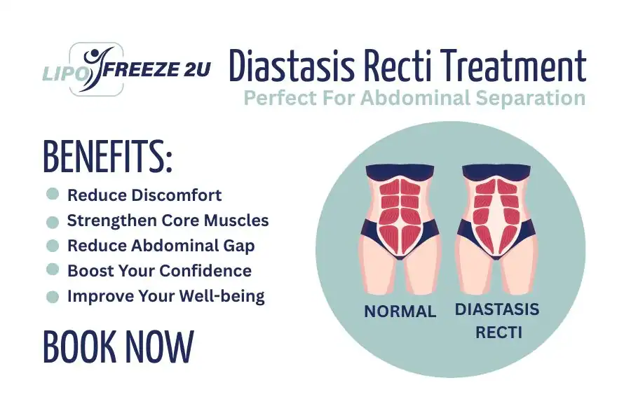 Benefits of body toning treatment Basildon for Diastasis recti