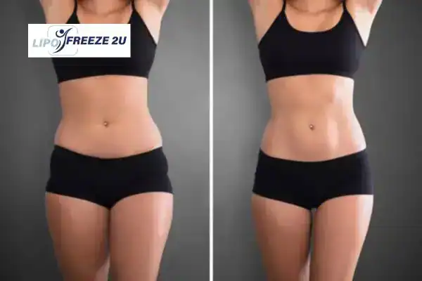 How Can LIPO FREEZE 2U Support Your Post-Pregnancy Body Recovery Basildon?