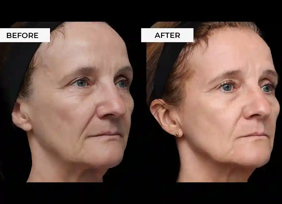 How Many RF Microneedling Sessions Will You Need to See a Difference Basildon?