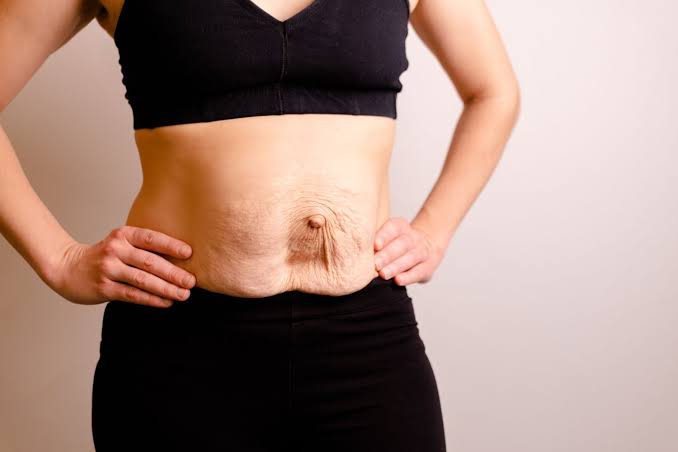 Is Surgery Really the Only Way to Repair Diastasis Recti Basildon?