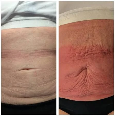 How Does RF Microneedling Improve Crepey, Thin and Uneven Skin Texture Basildon?