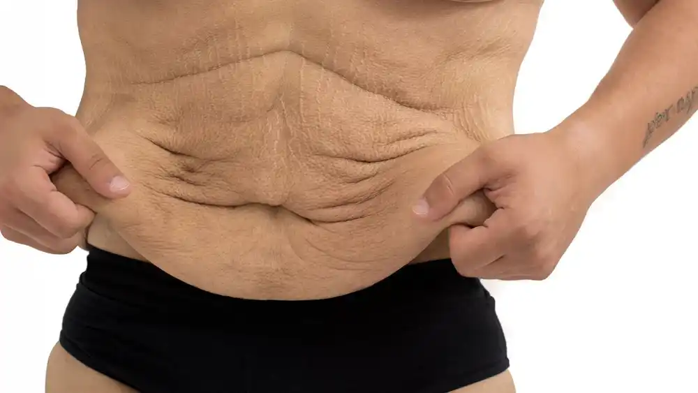 Why Does Weight Loss Medication Leave Some People With Loose or Sagging Skin Basildon?